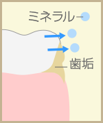 歯の表面（エナメル質）が溶け出し、初期のむし歯が発生した状態です。