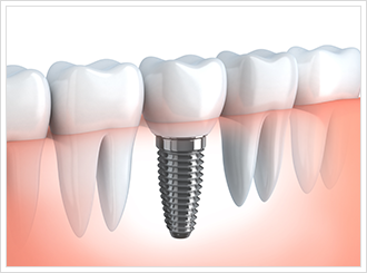 インプラント