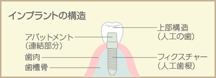 インプラントの構造